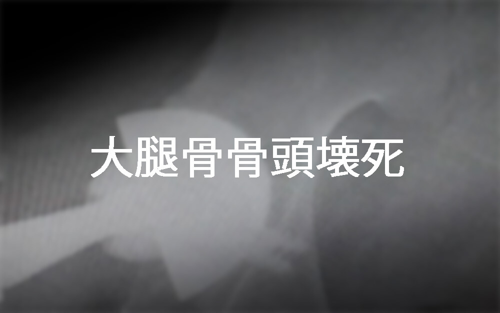 ”大腿骨骨頭壊死”はマジで痛い